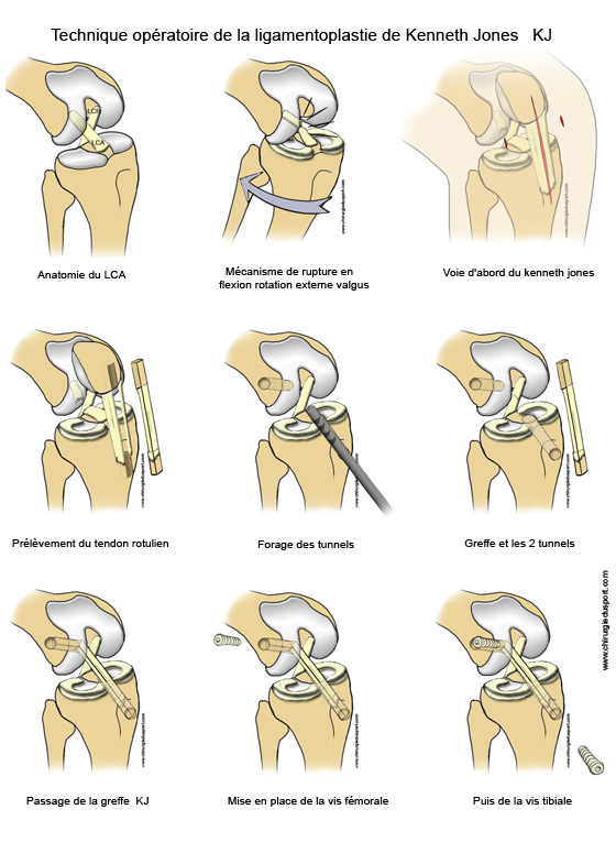 La fiche_de_la_ligamentoplastie_type_KJ_kenneth_jones_chirurgiedusport.jpg