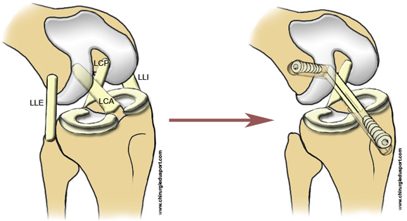 images dessin_ANATOMIE_DIDT_rupture_LCA_ligament_genou_menisque_chirurgiedusport_docteur_lefevre