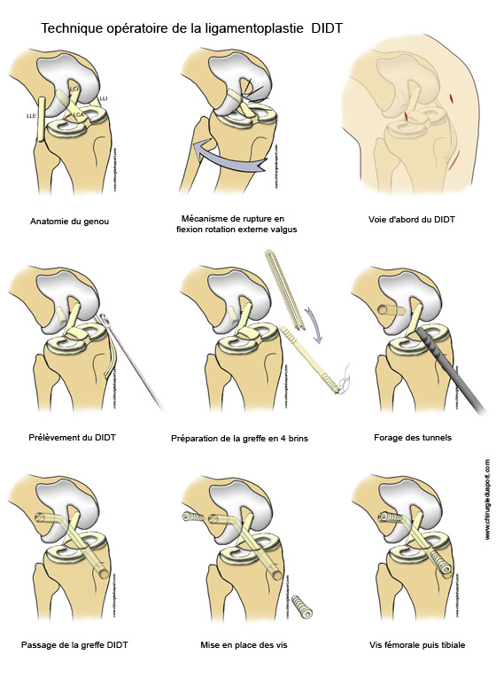 /images/fiche_technique_ligamentoplastie_didt_lca_chirurgiedusport_ligament_genou_kj_entorse_docteur_lefevre