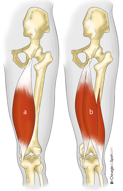 Fig 1   le groupe musculaire ischio jambier   a) muscle semi membraneux b) muscle semi-tendineux et biceps docteur lefevre nicolas yoann bohu