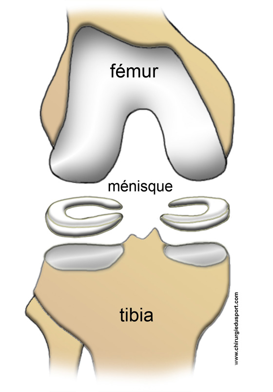 ménisque fissuré 